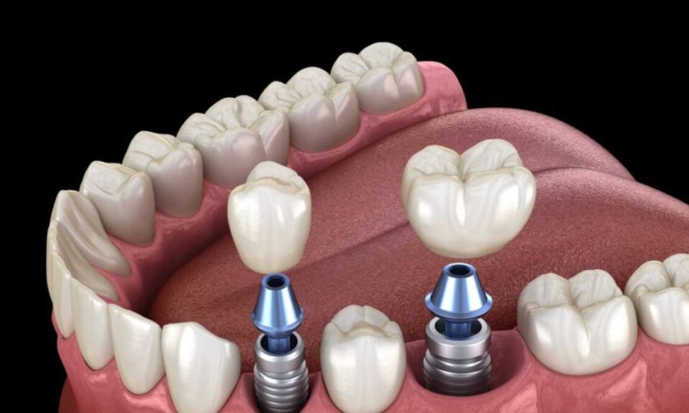How All-on-4 Implants in Joondalup Improve Your Comfort and Function Compared to Conventional Methods