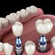 How All-on-4 Implants in Joondalup Improve Your Comfort and Function Compared to Conventional Methods